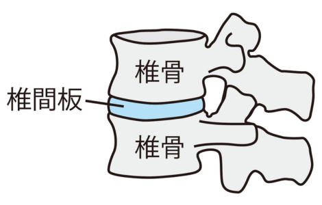 腰痛の原因となる椎間板の説明